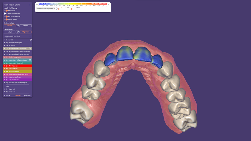 EXOCAD DİJİTAL İŞ AKIŞI